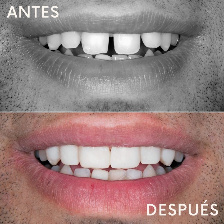 antes-despues-carillas-dentales-madrid-01