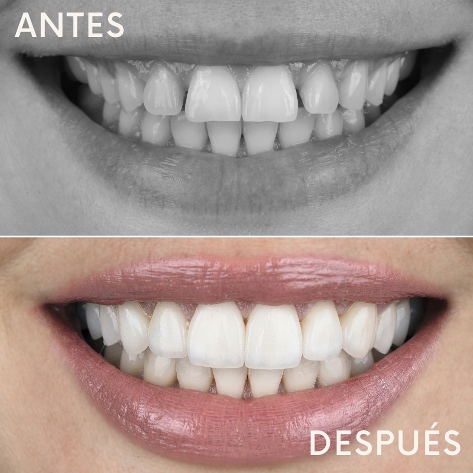 antes-despues-carillas-dentales-madrid-02